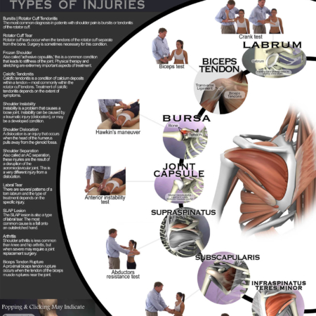 Poster showing various types of shoulder pain