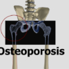 from the video anatomy and pathology for bodyworkers, osteoporosis image